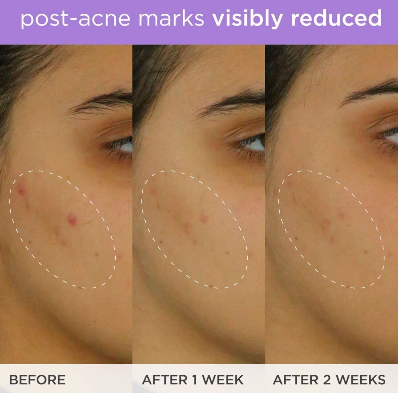 imageThe Brightening Serum  Vitamin C Treatment for Brighter Firmer Skin  Targets Hyperpigmentation ampamp Fades PostAcne Marks 30 ml  10 fl oz